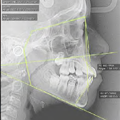 I-Arch - Torque delivery in the early stage of the treatment - Case Report - ZOOM - prima pagina a catalogului